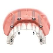 K1 Implant Choice - All on 4 - Full Mouth Dental Implants in one Day