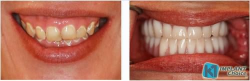 K1 Implant Choice - All on 4 - Full Mouth Dental Implants in one Day